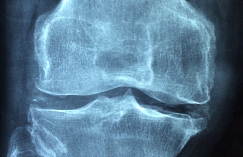 Arthrose